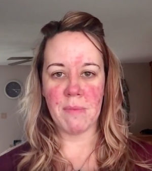 Rosacea Hautpflege Tipps