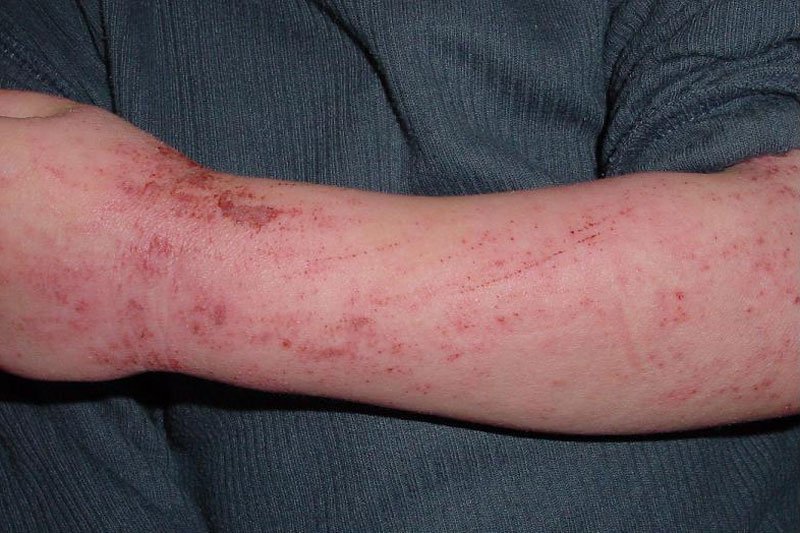 Neurodermitis am Arm eines 5-jährigen Kindes