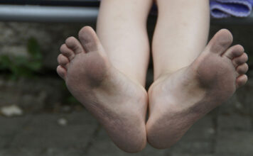 Warzen – wie sie entstehen und wie man sie wieder entfernen kann Fusssohlen mit Warzen