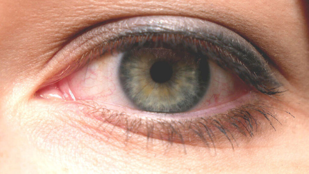 Wann Wieder Wimperntusche Nach Grauer Star Op Grauer Star: Was vor und nach der Operation zu beachten ist | myPfadFinder